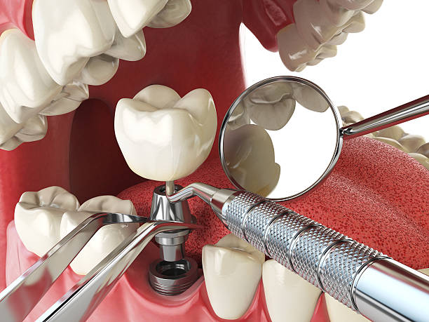 Best Emergency Dentist for Knocked-Out Tooth in Burnham, PA